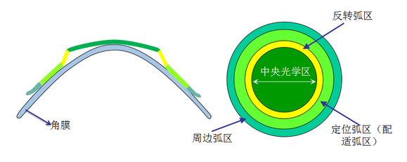 角膜塑形镜降低近视度数的原理