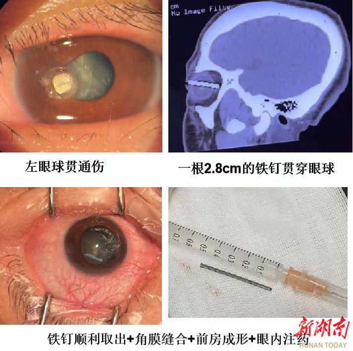 三厘米铁钉刺穿眼球！这家医院让患者重获光明